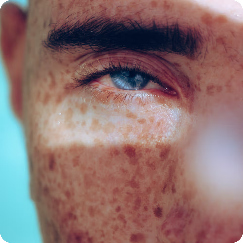 Image of a man with freckles on his face, smiling warmly, showcasing his unique features